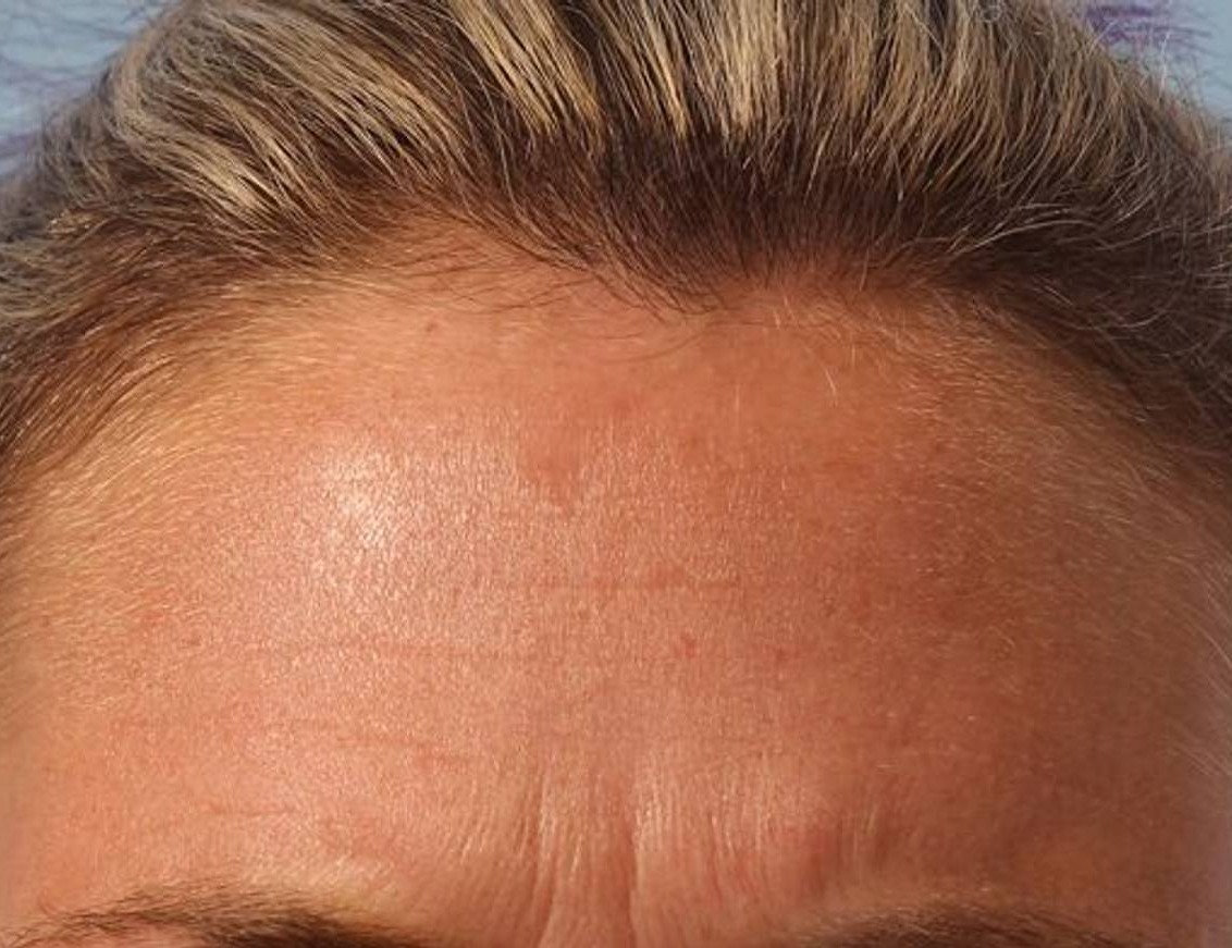 Botox/Dysport Before & After Image
