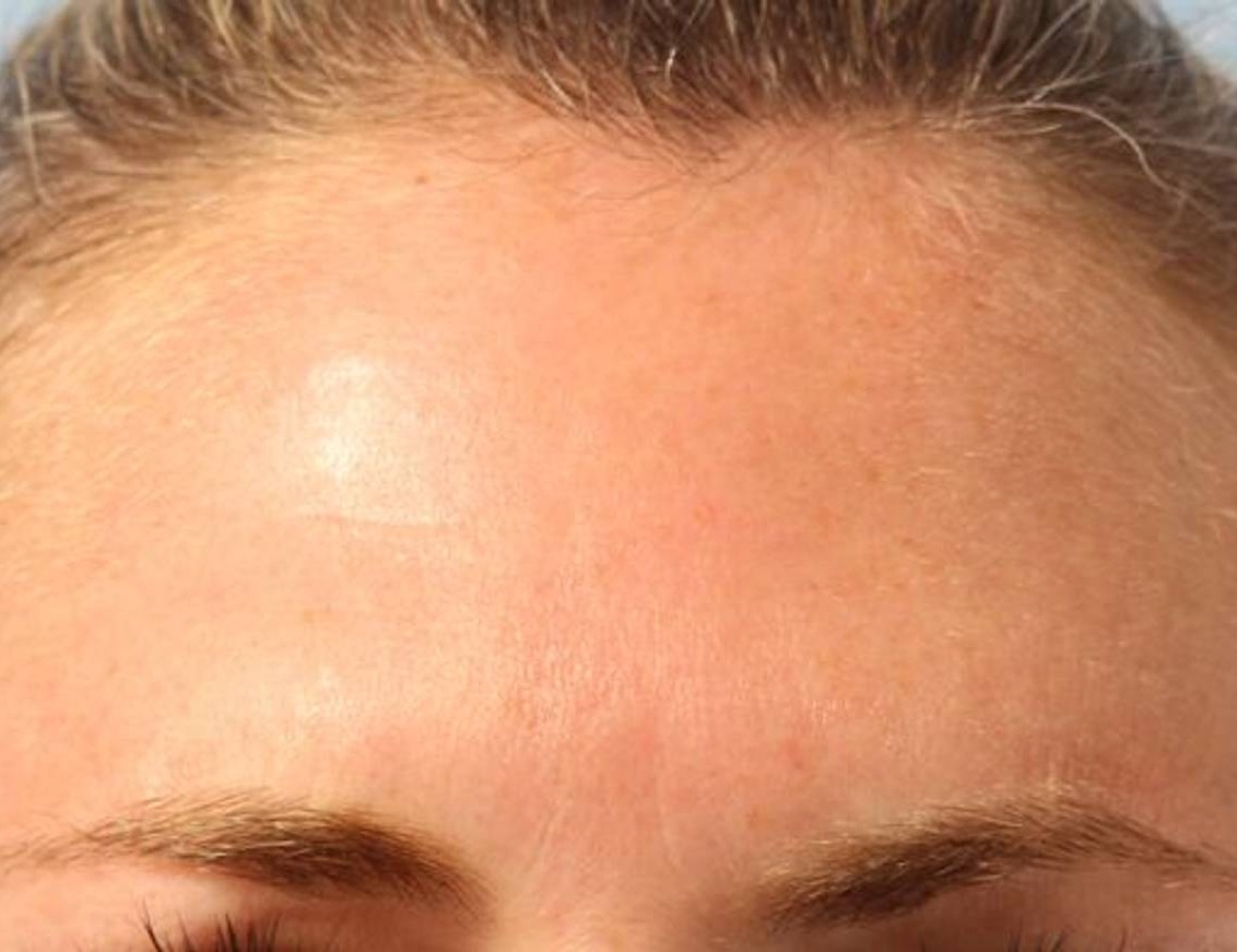 Botox/Dysport Before & After Image