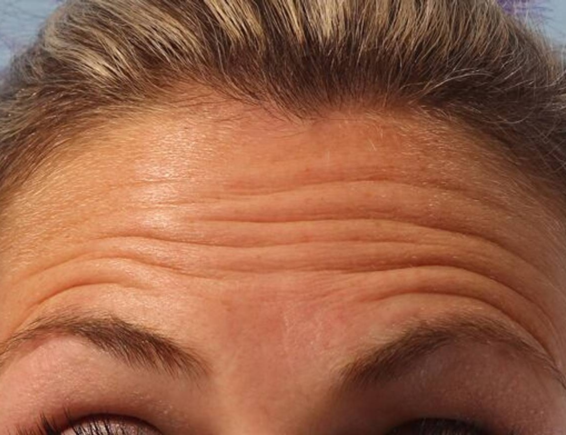 Botox/Dysport Before & After Image
