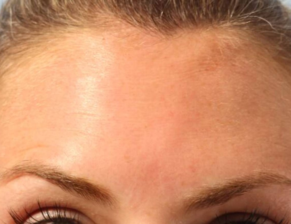 Botox/Dysport Before & After Image