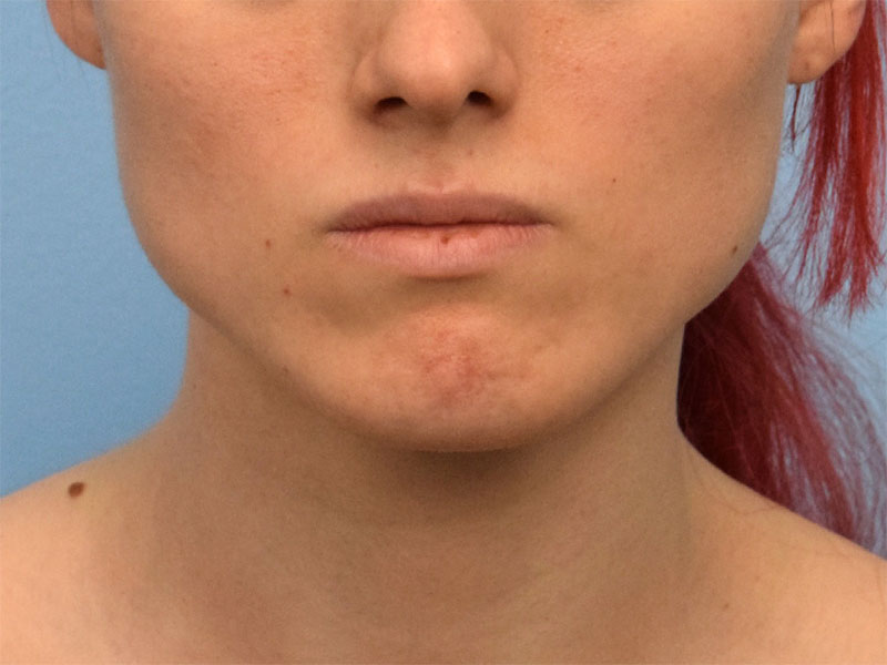 Botox/Dysport Before & After Image