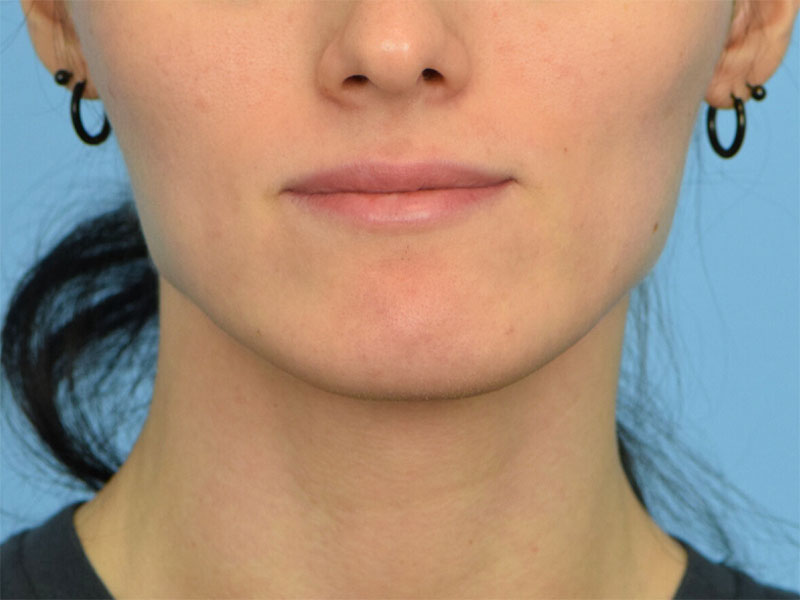 Botox/Dysport Before & After Image