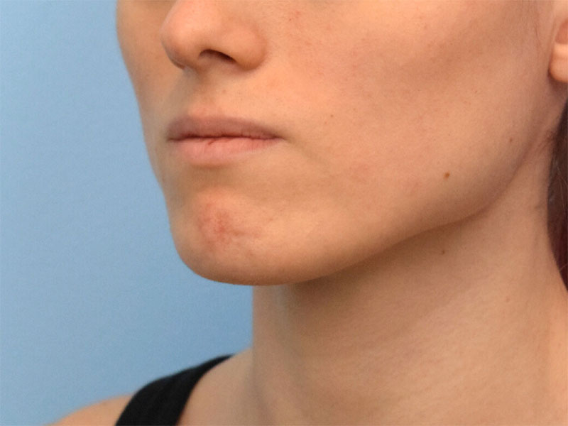 Botox/Dysport Before & After Image