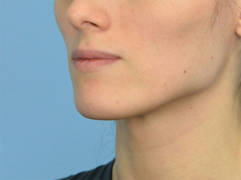 Botox/Dysport Before & After Image