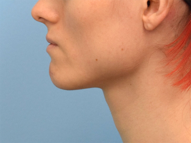 Botox/Dysport Before & After Image