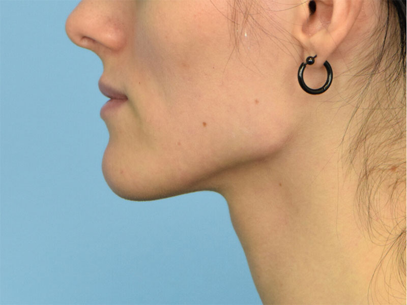 Botox/Dysport Before & After Image