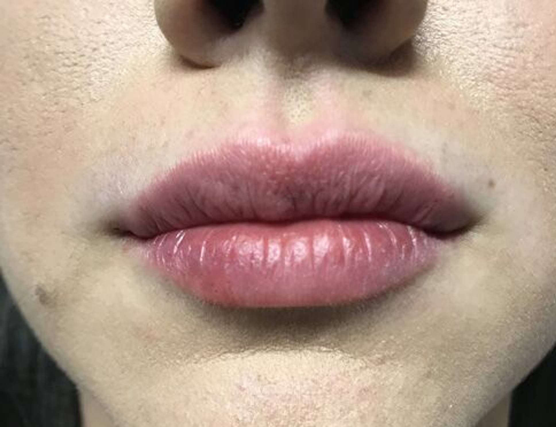 Lip Augmentation Before & After Image