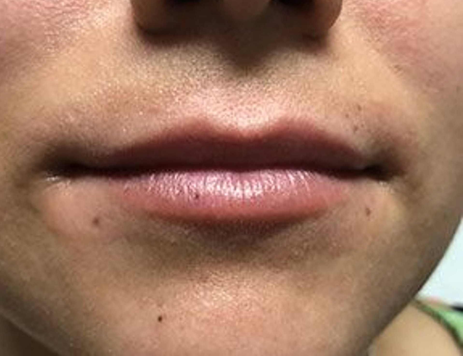 Lip Augmentation Before & After Image