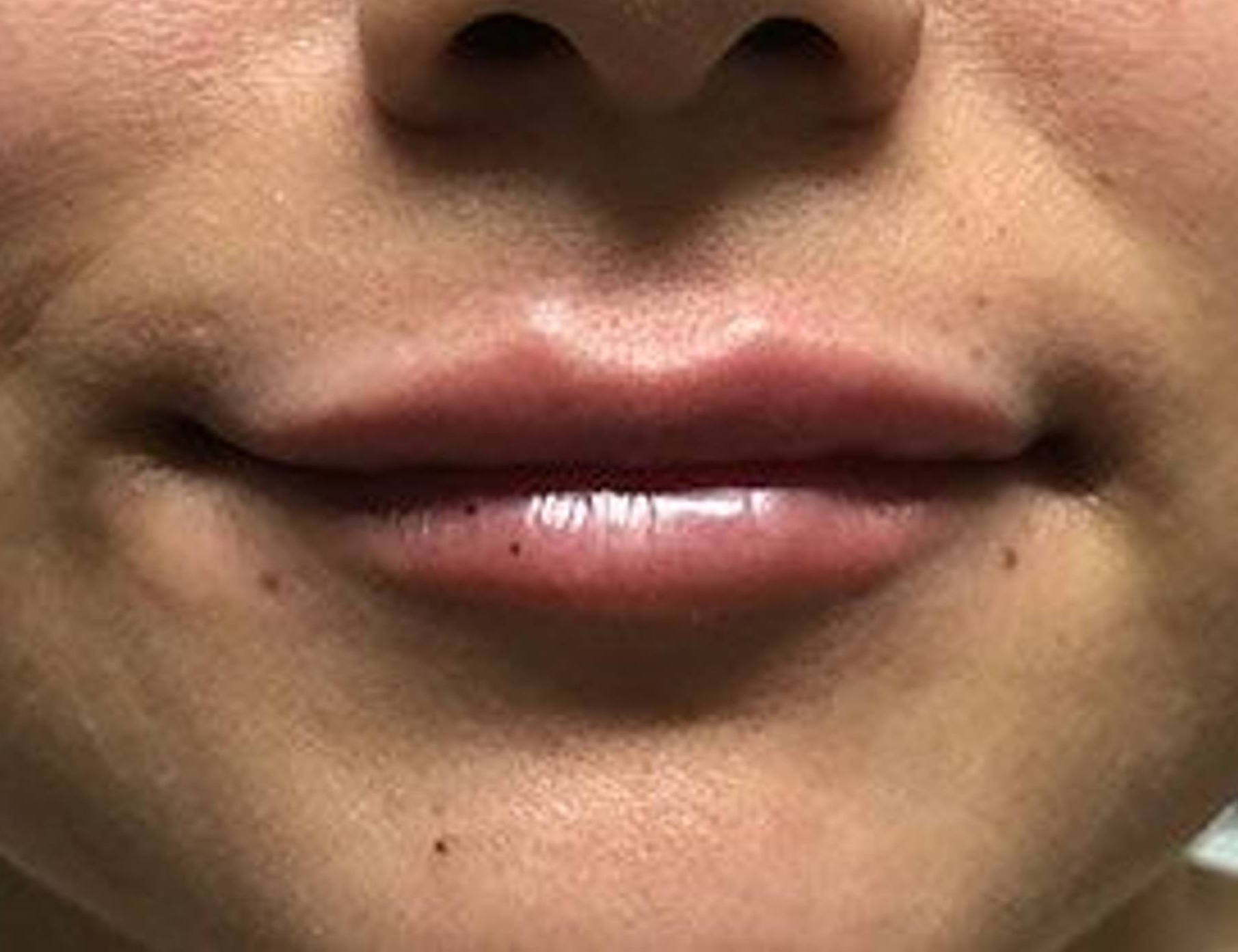 Lip Augmentation Before & After Image