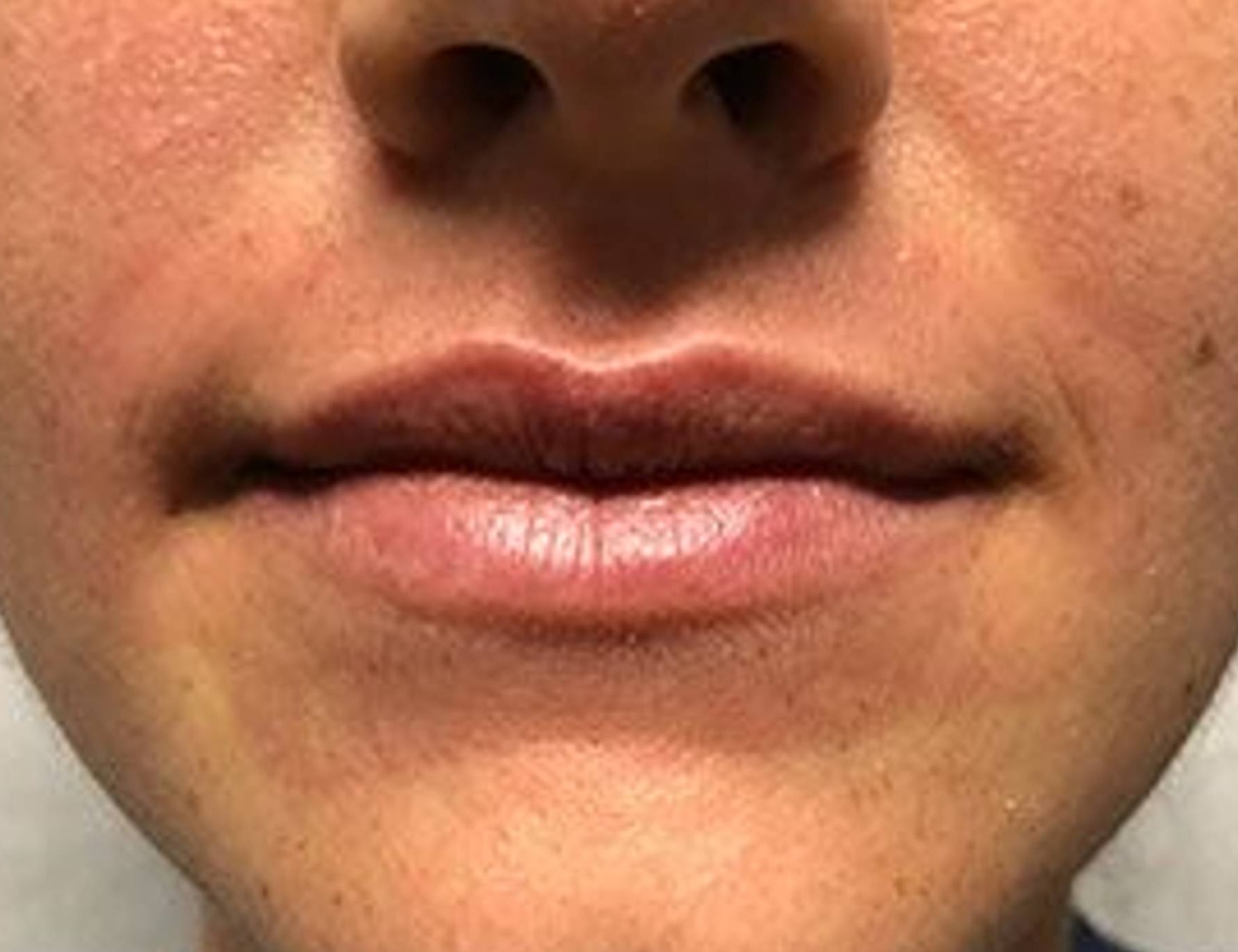 Lip Augmentation Before & After Image