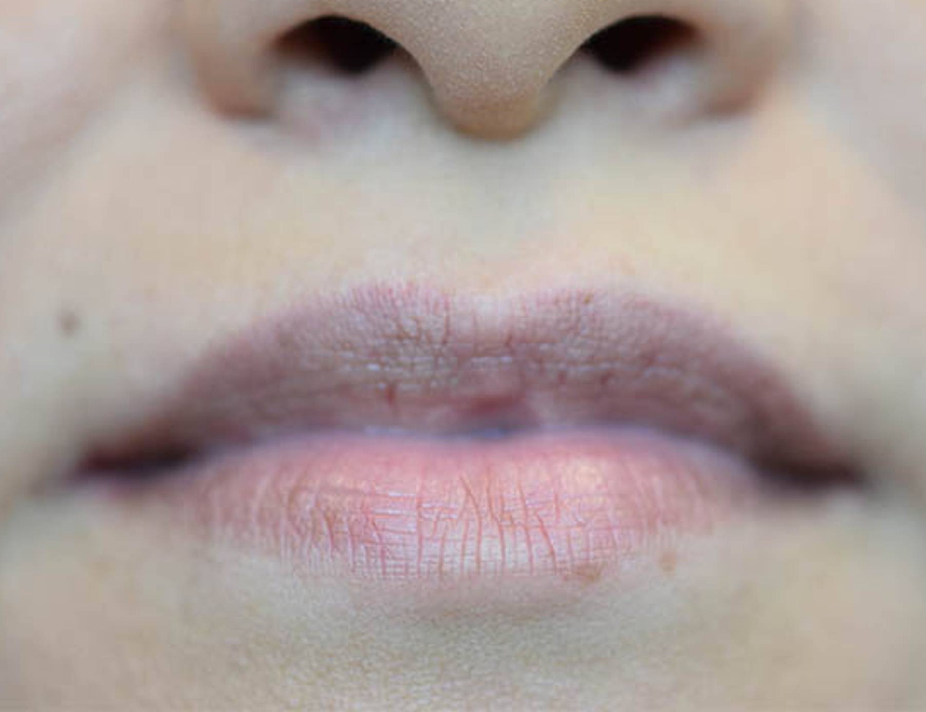 Lip Augmentation Before & After Image