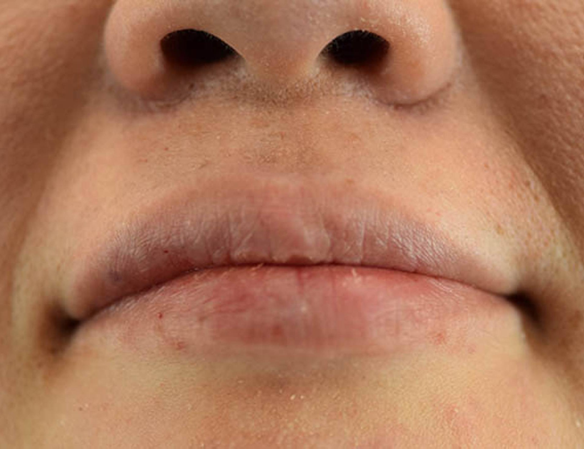 Lip Augmentation Before & After Image