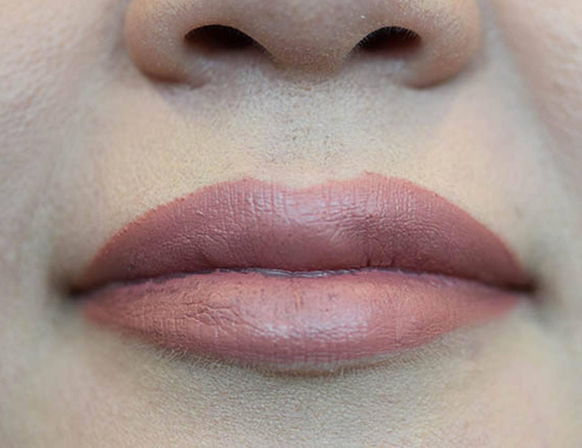 Lip Augmentation Before & After Image