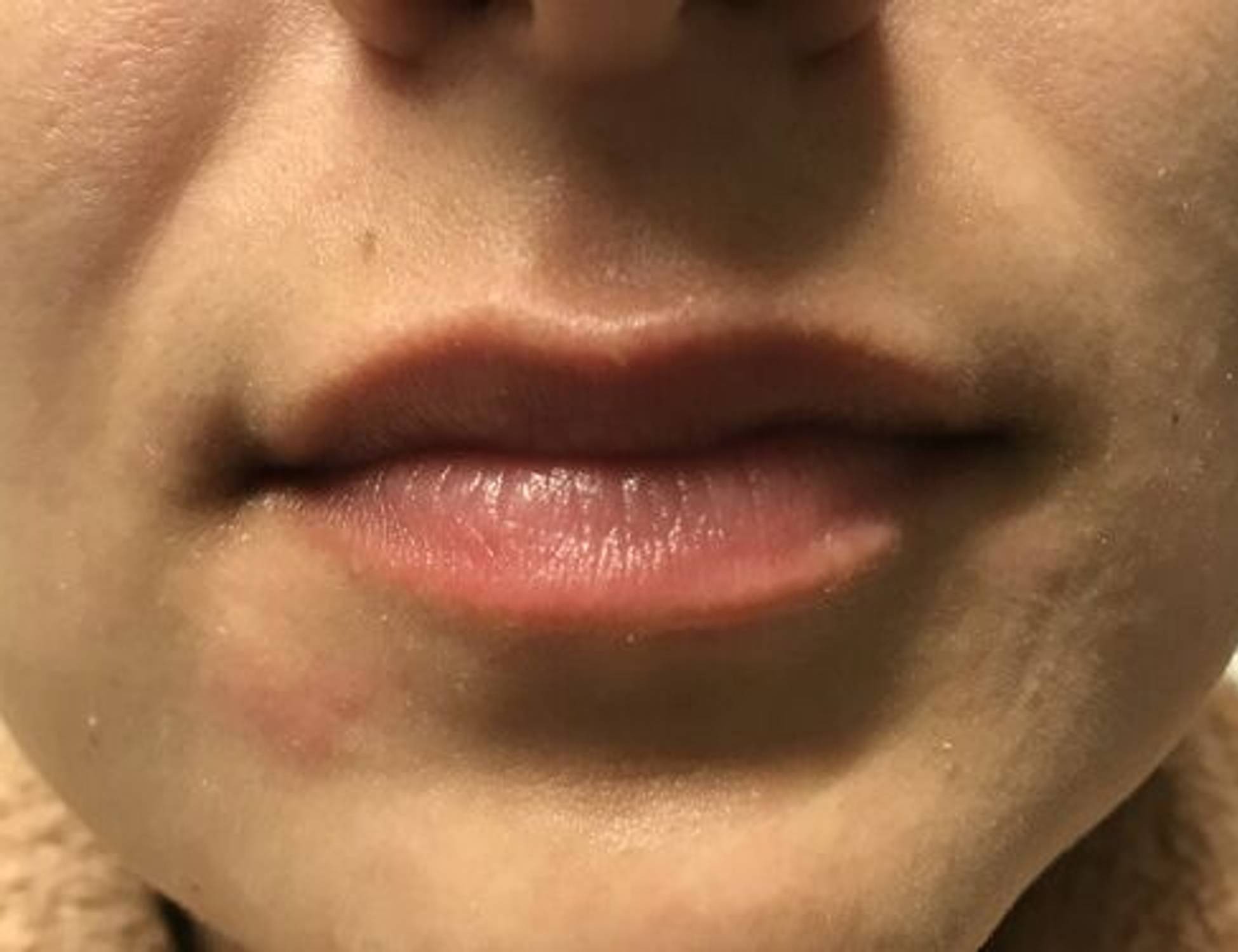 Lip Augmentation Before & After Image