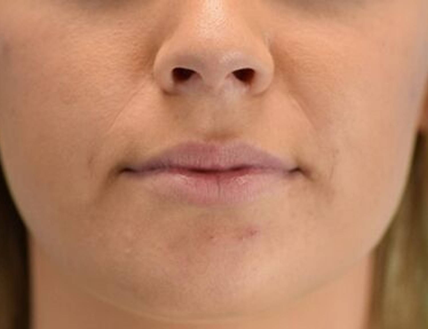 Lip Augmentation Before & After Image