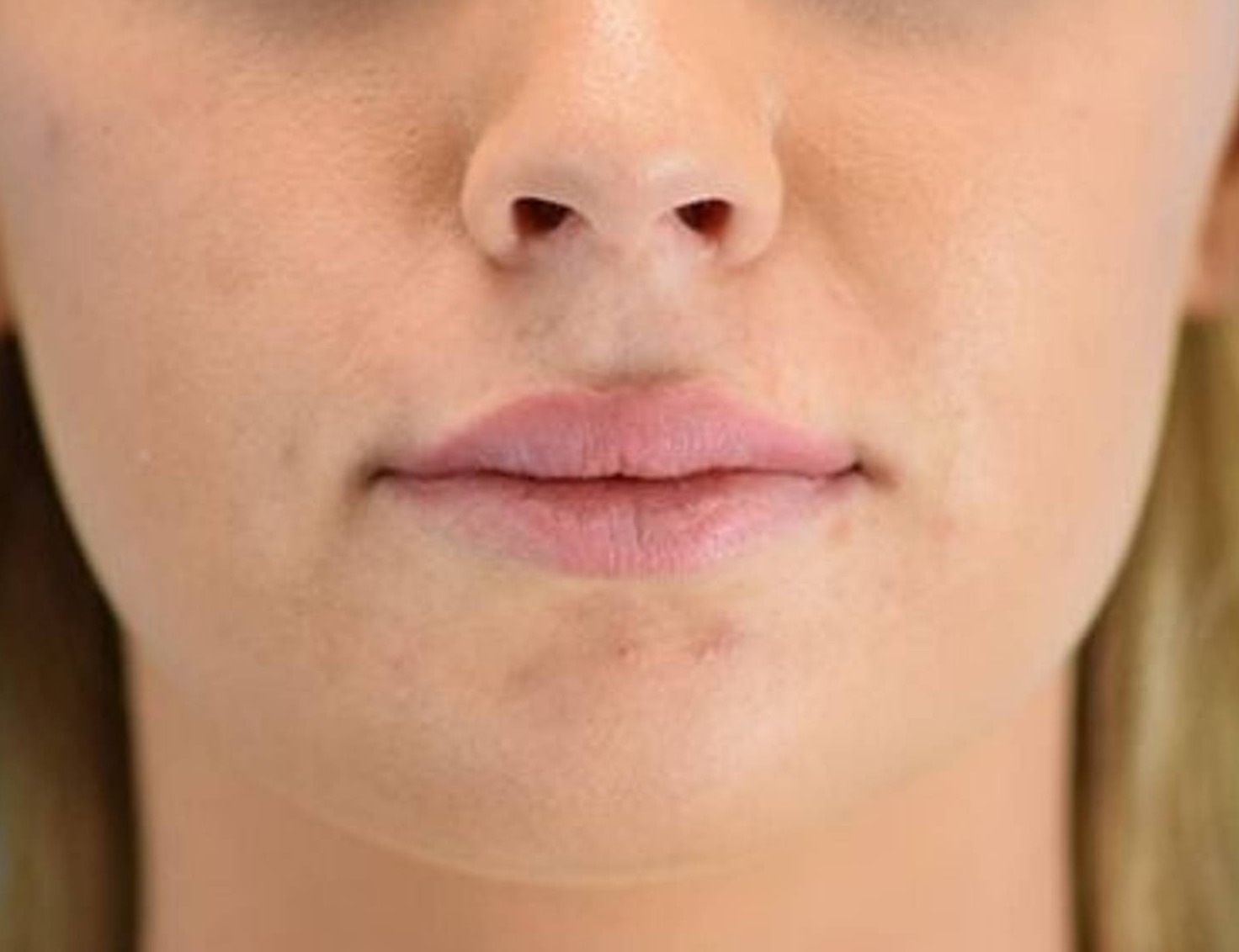 Lip Augmentation Before & After Image