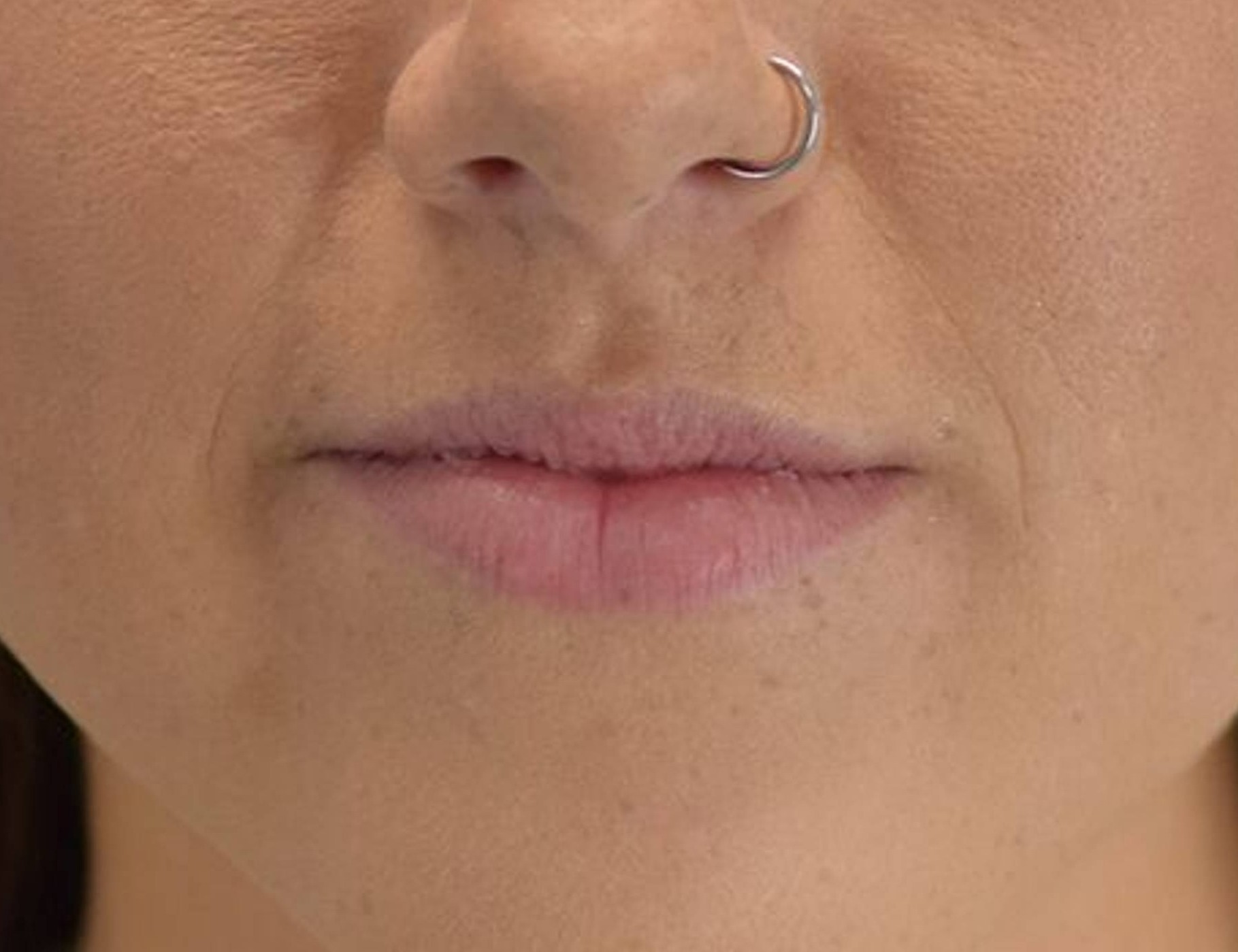 Lip Augmentation Before & After Image