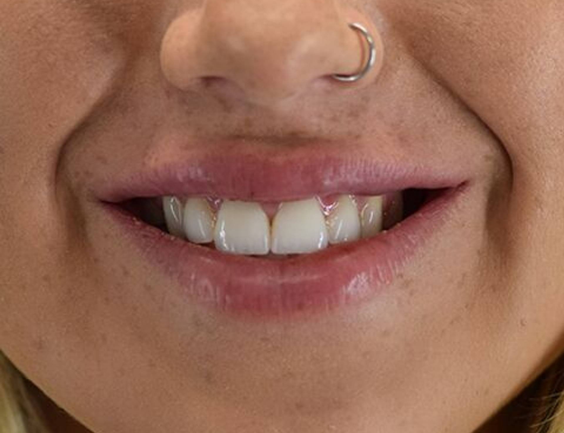 Lip Augmentation Before & After Image