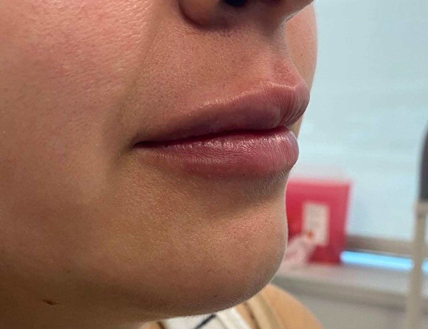 Lip Augmentation Before & After Image