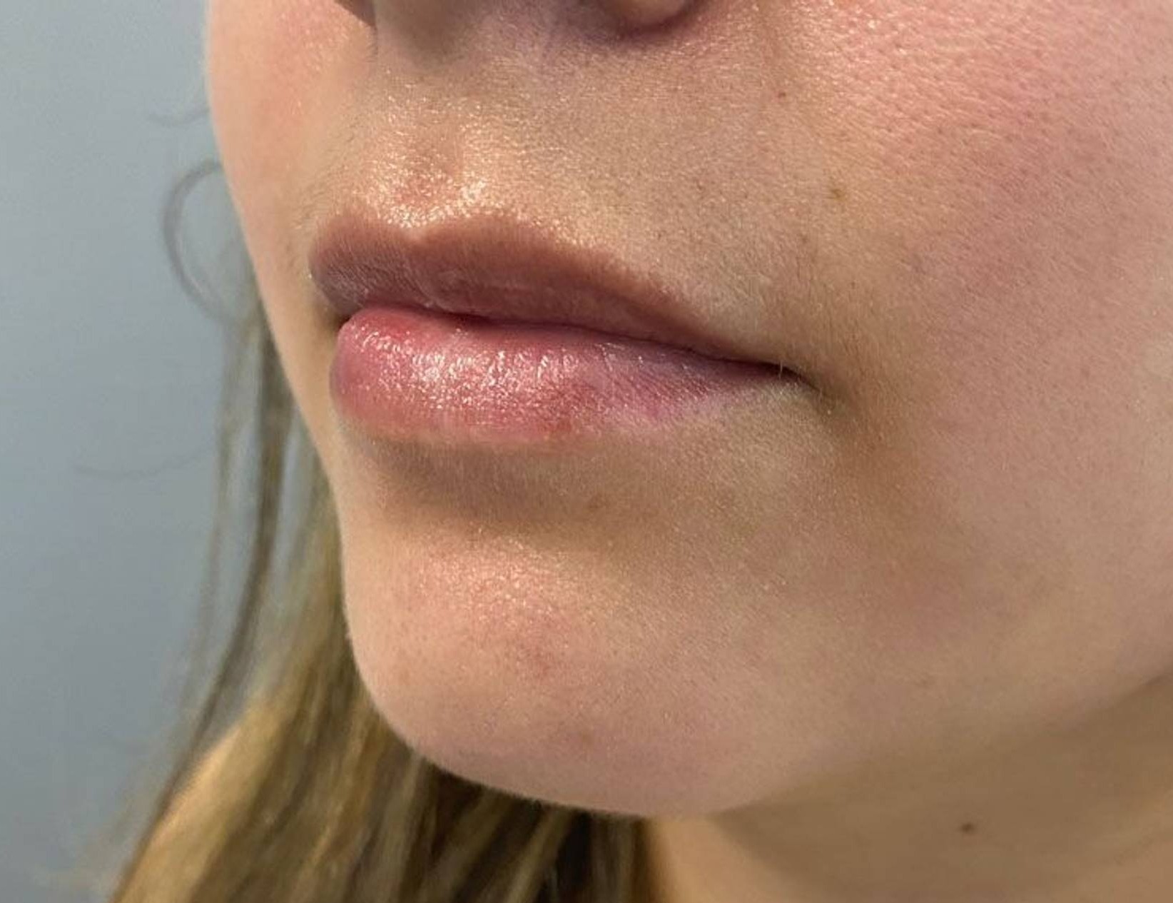 Lip Augmentation Before & After Image