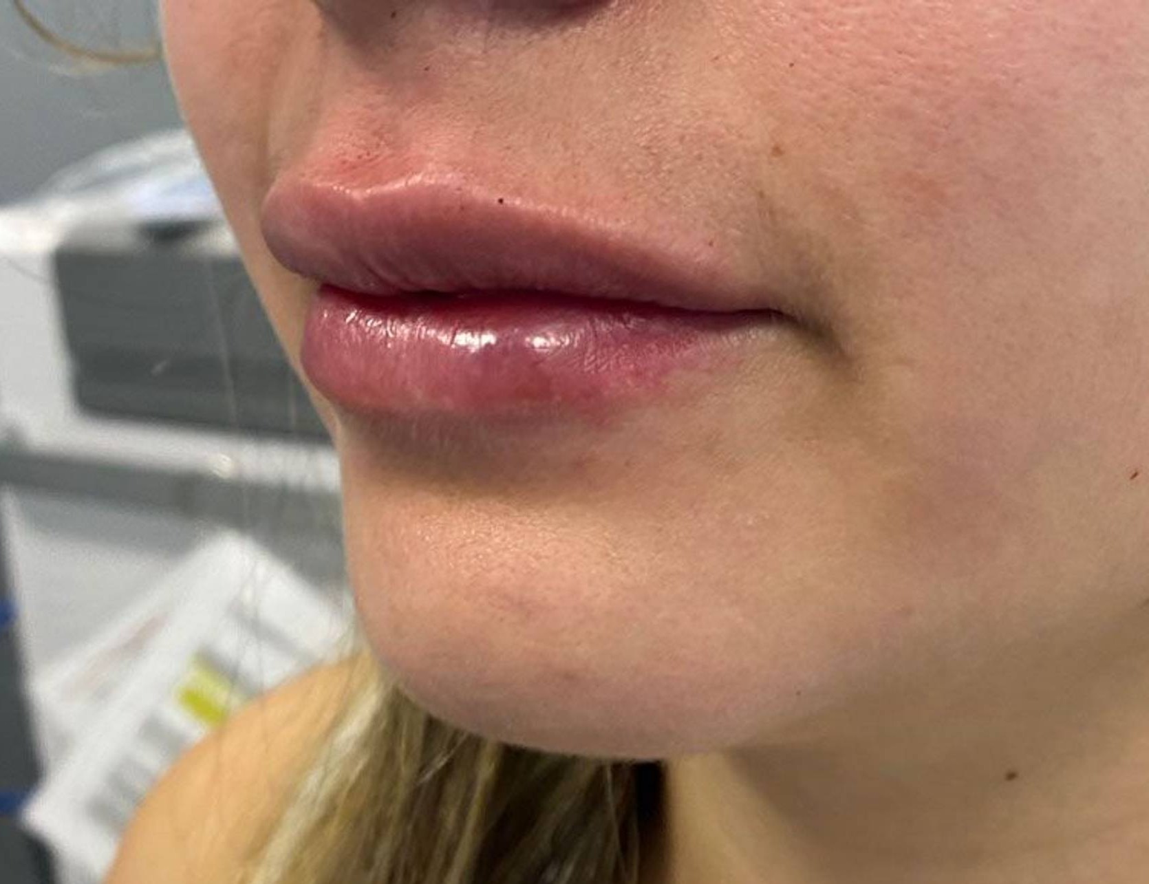 Lip Augmentation Before & After Image