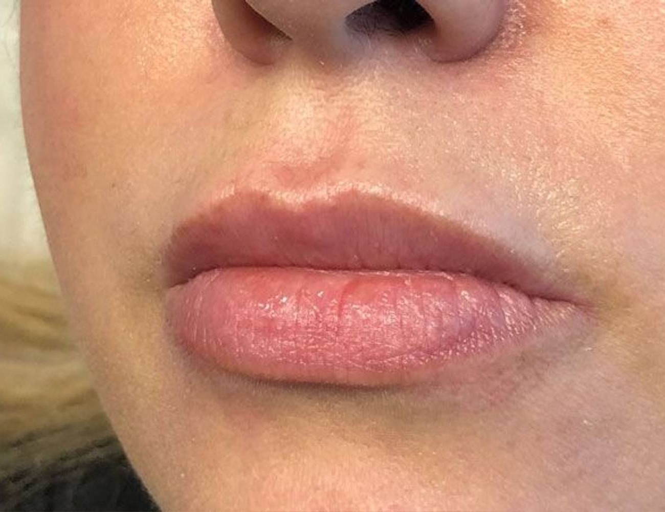 Lip Augmentation Before & After Image