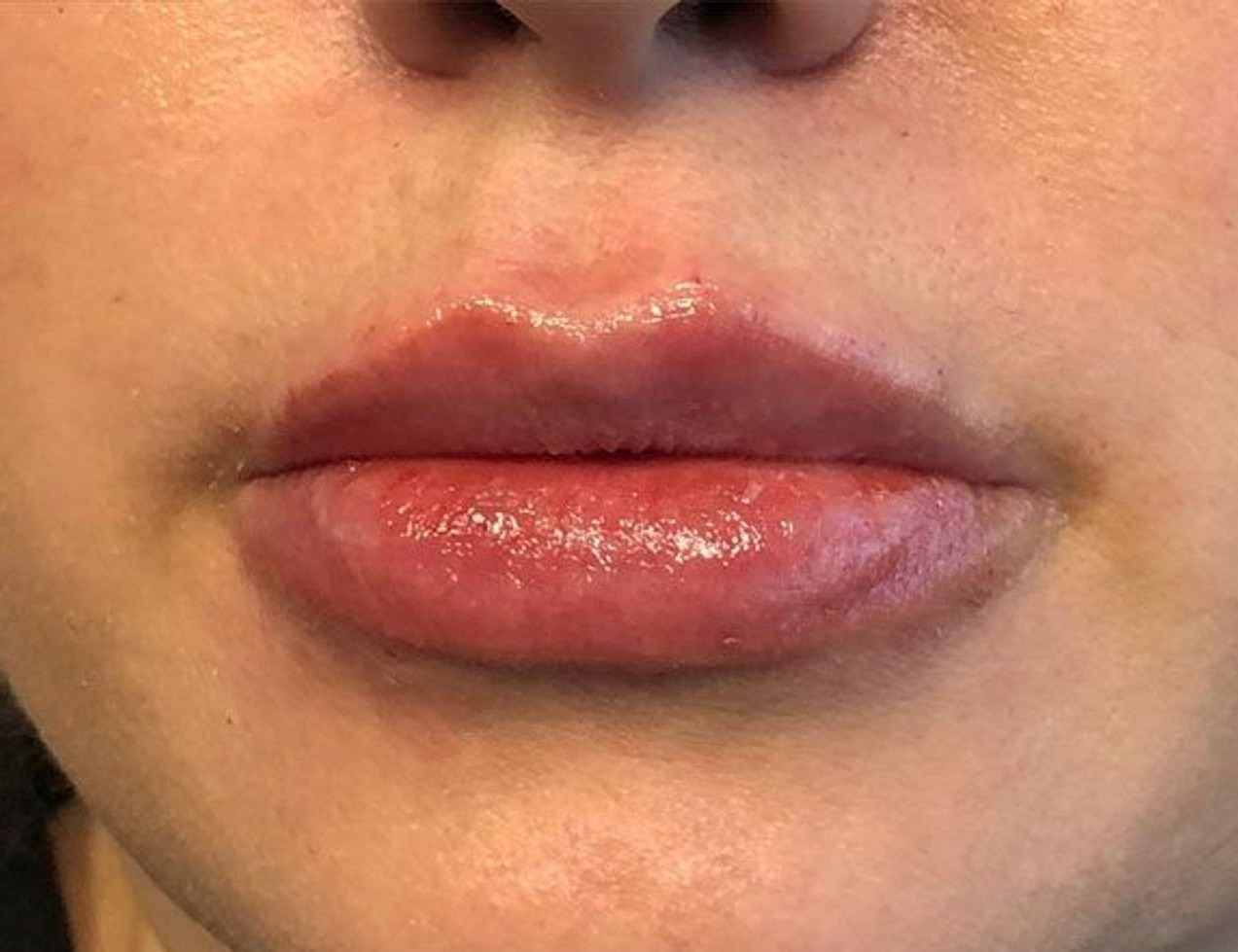 Lip Augmentation Before & After Image