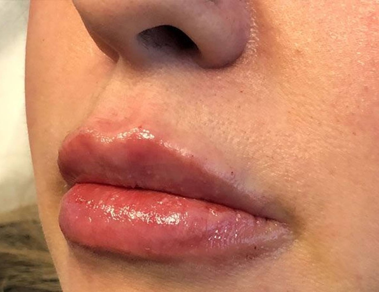 Lip Augmentation Before & After Image