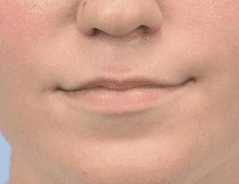 Lip Augmentation Before & After Image