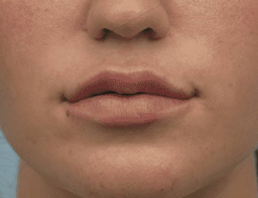 Lip Augmentation Before & After Image