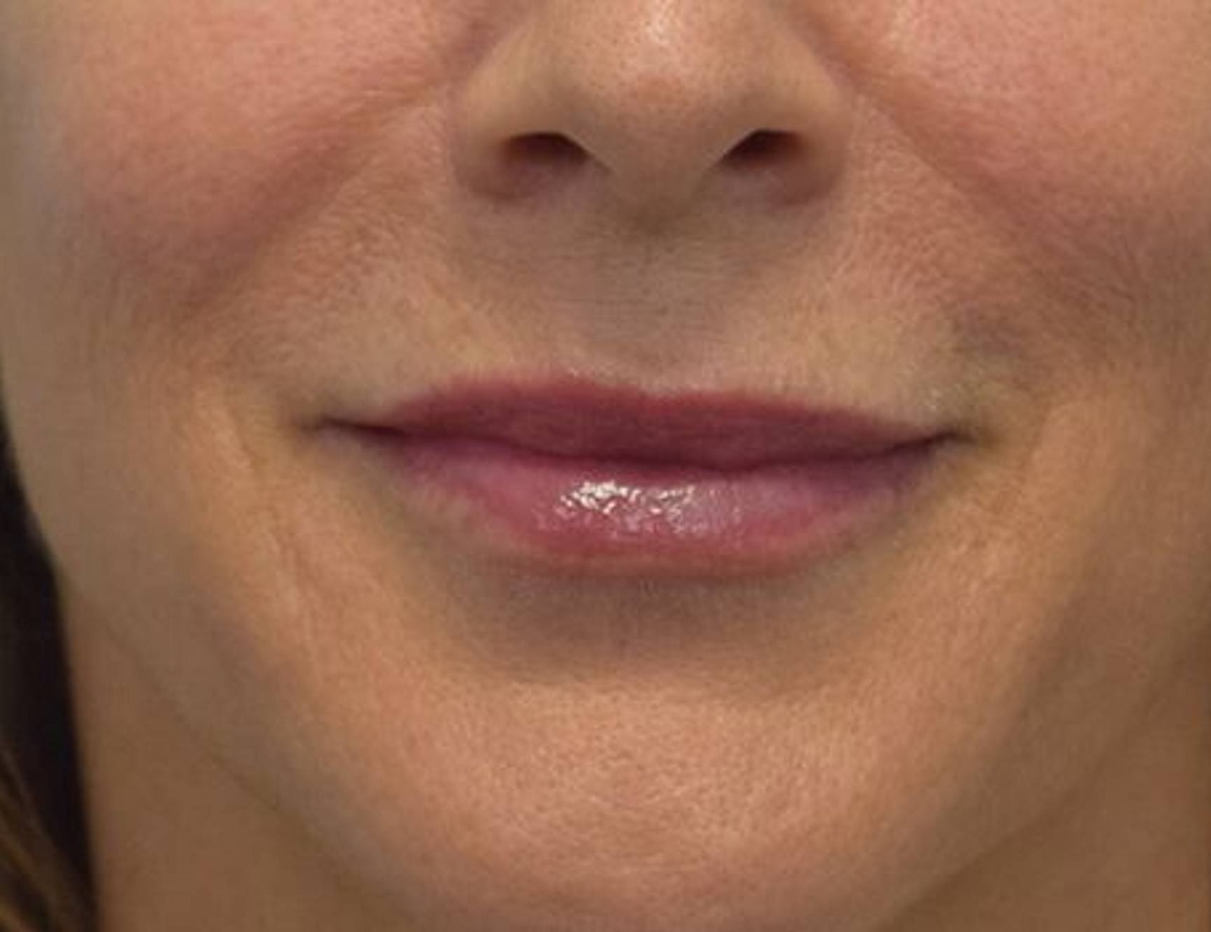 Lip Augmentation Before & After Image