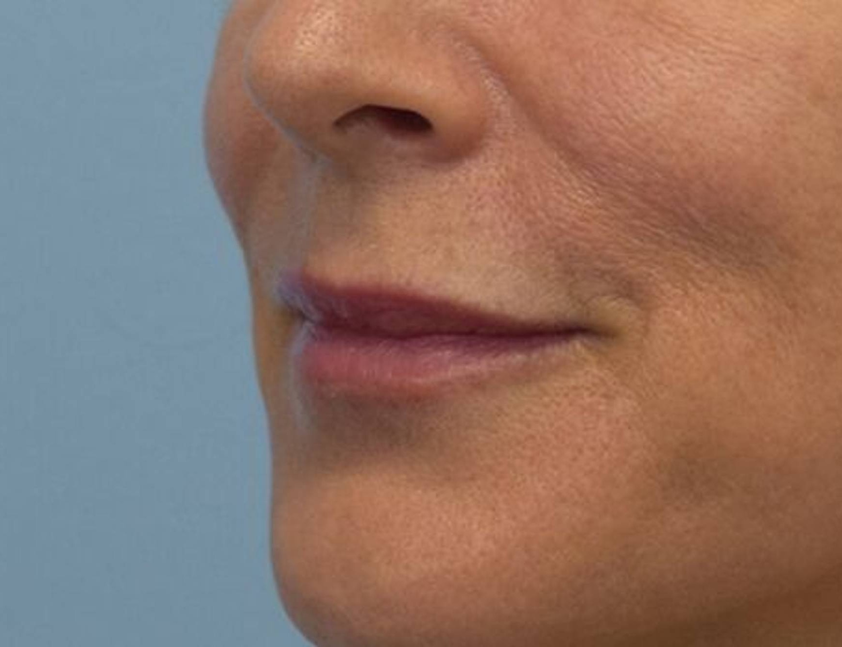 Lip Augmentation Before & After Image