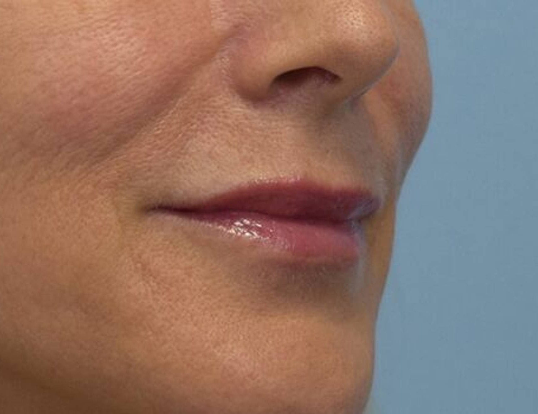 Lip Augmentation Before & After Image