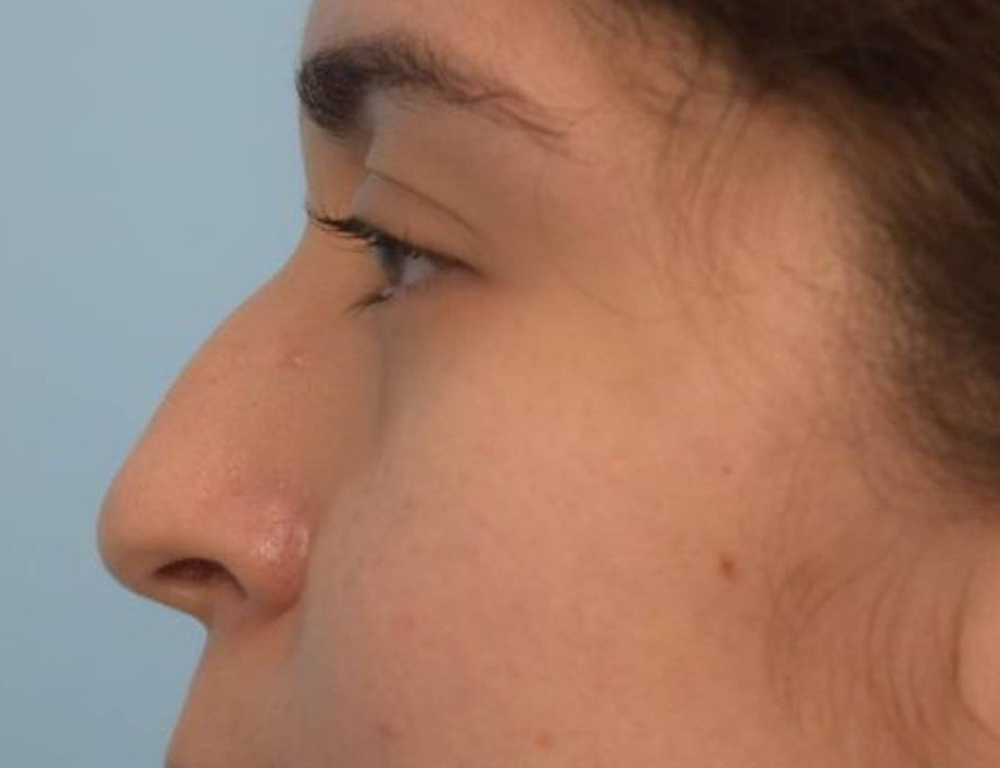 Liquid Rhinoplasty Before & After Image