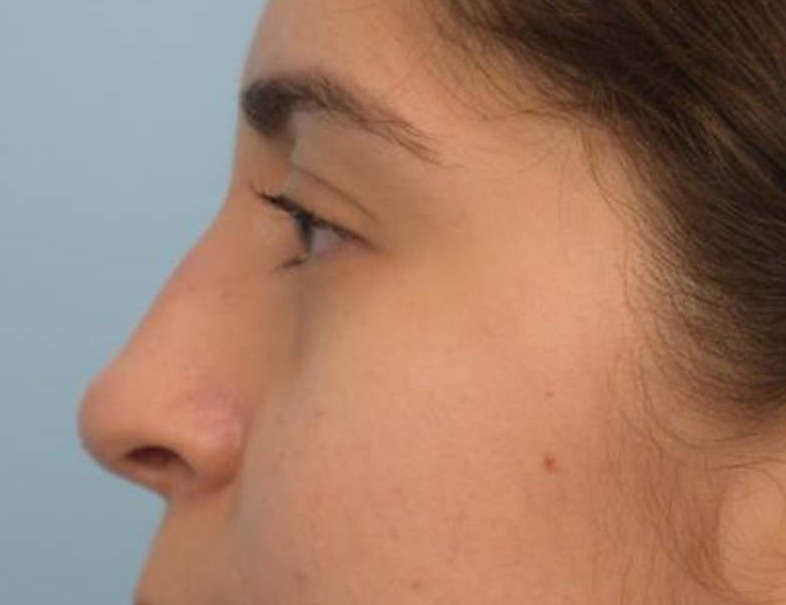 Liquid Rhinoplasty Before & After Image