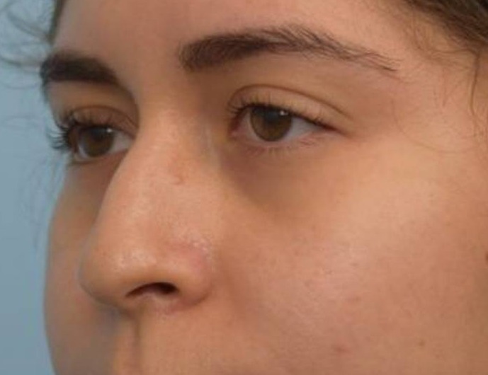 Liquid Rhinoplasty Before & After Image