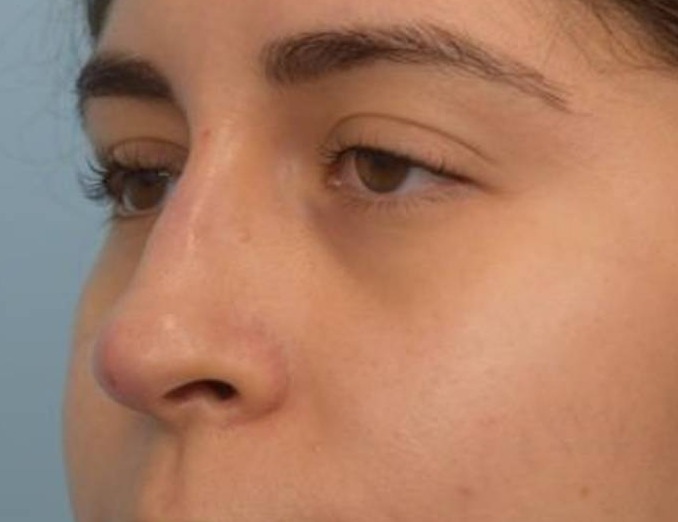 Liquid Rhinoplasty Before & After Image