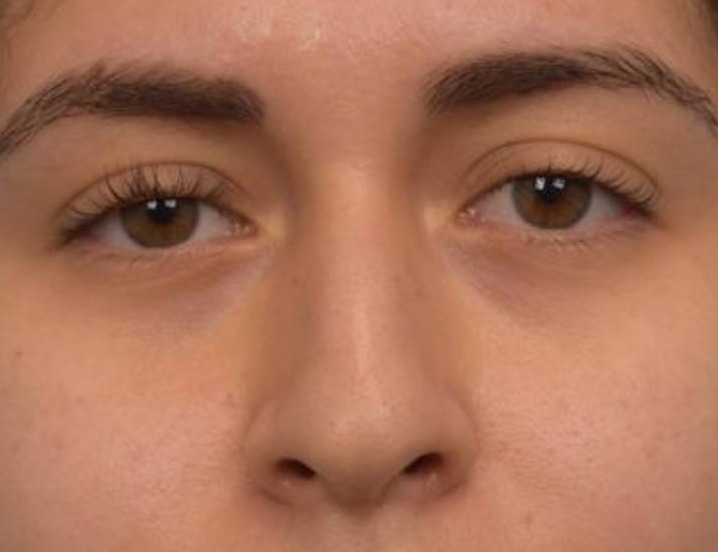 Liquid Rhinoplasty Before & After Image