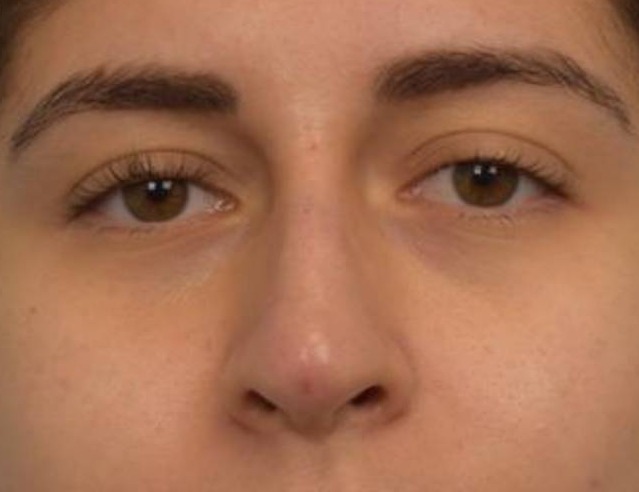 Liquid Rhinoplasty Before & After Image