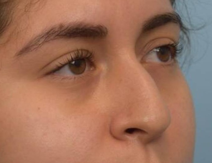 Liquid Rhinoplasty Before & After Image