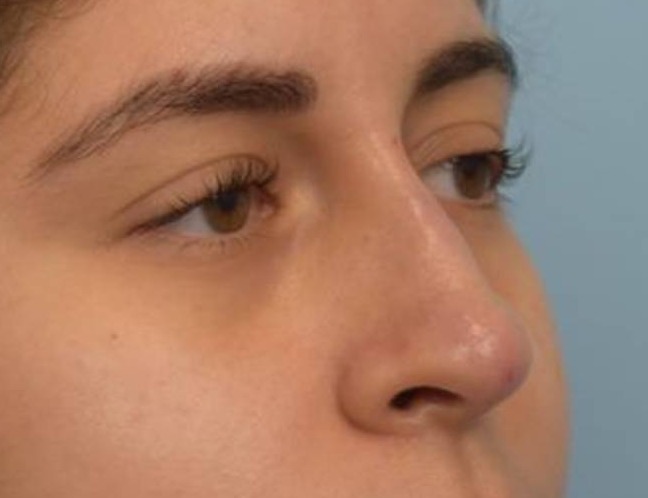 Liquid Rhinoplasty Before & After Image