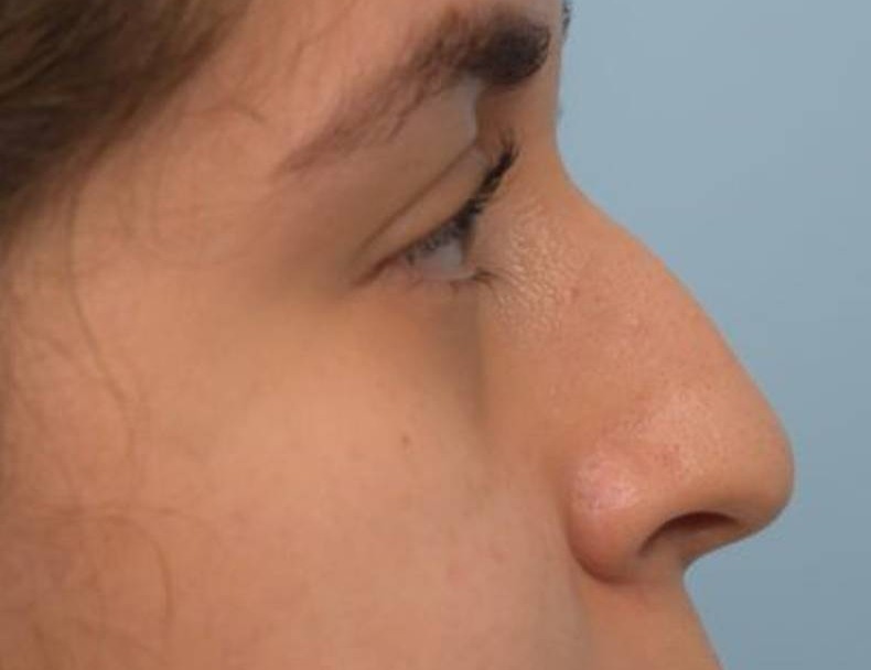 Liquid Rhinoplasty Before & After Image