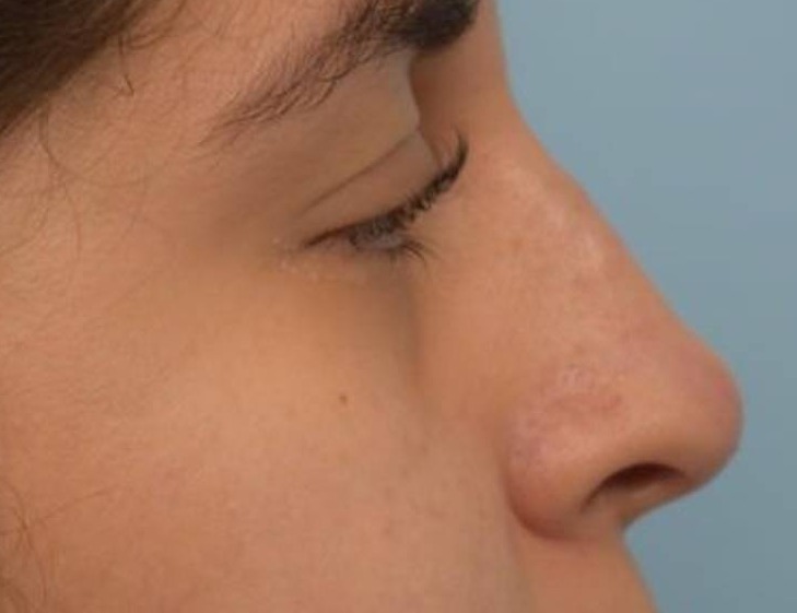 Liquid Rhinoplasty Before & After Image