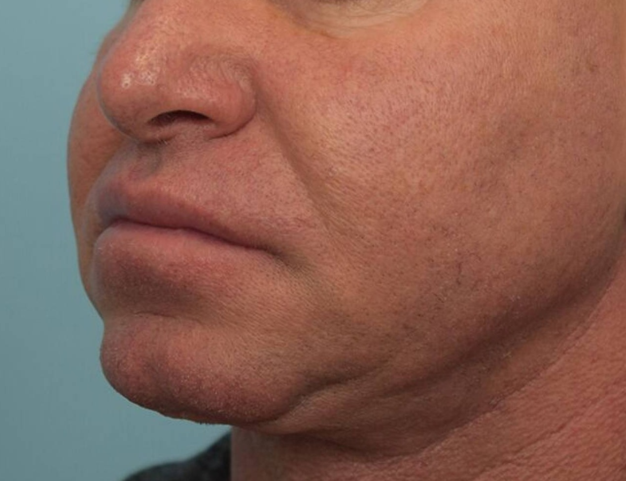 Lip Lift Before & After Image