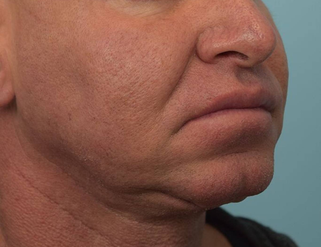 Lip Lift Before & After Image