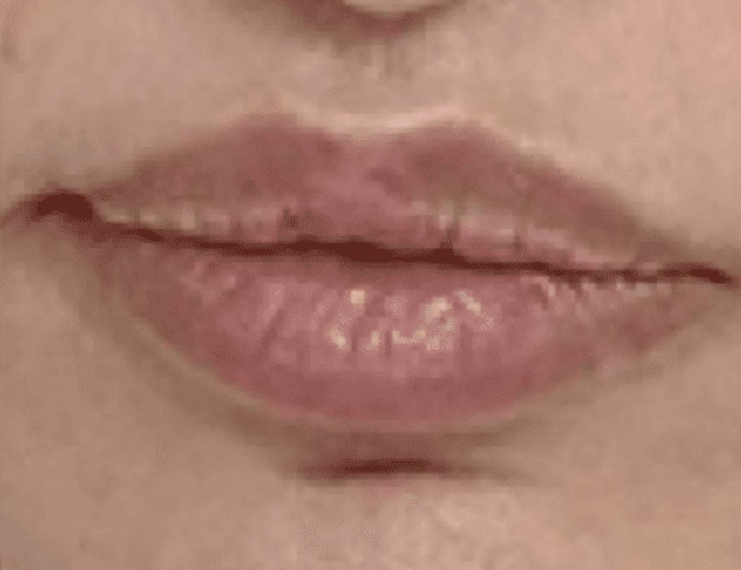 Lip Lift Before & After Image