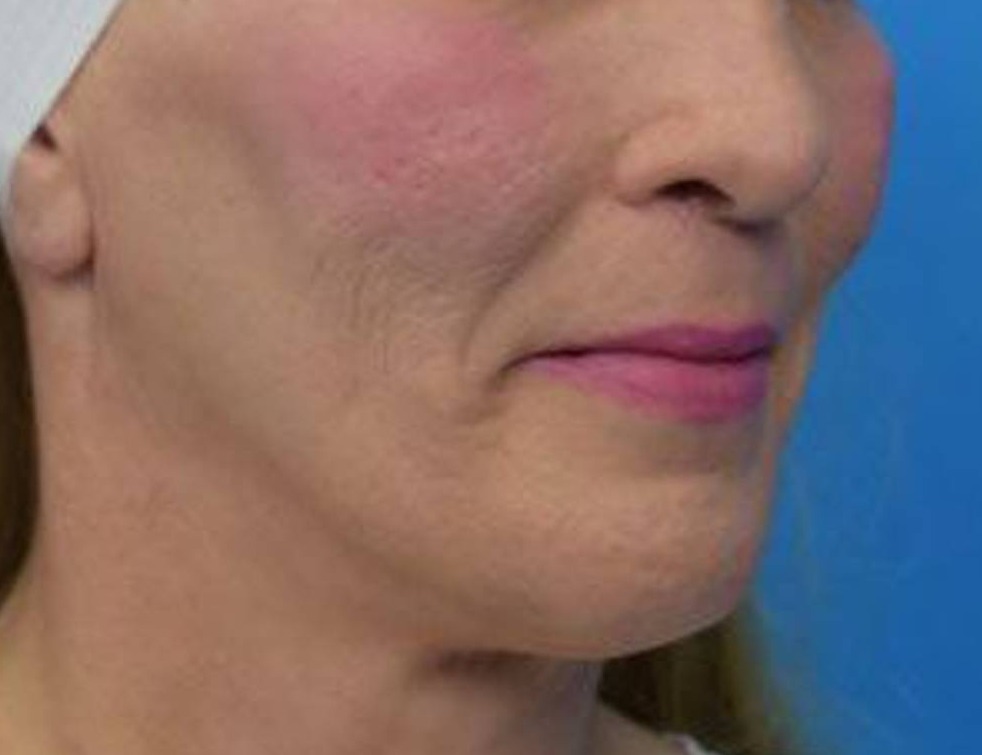 Lip Lift Before & After Image