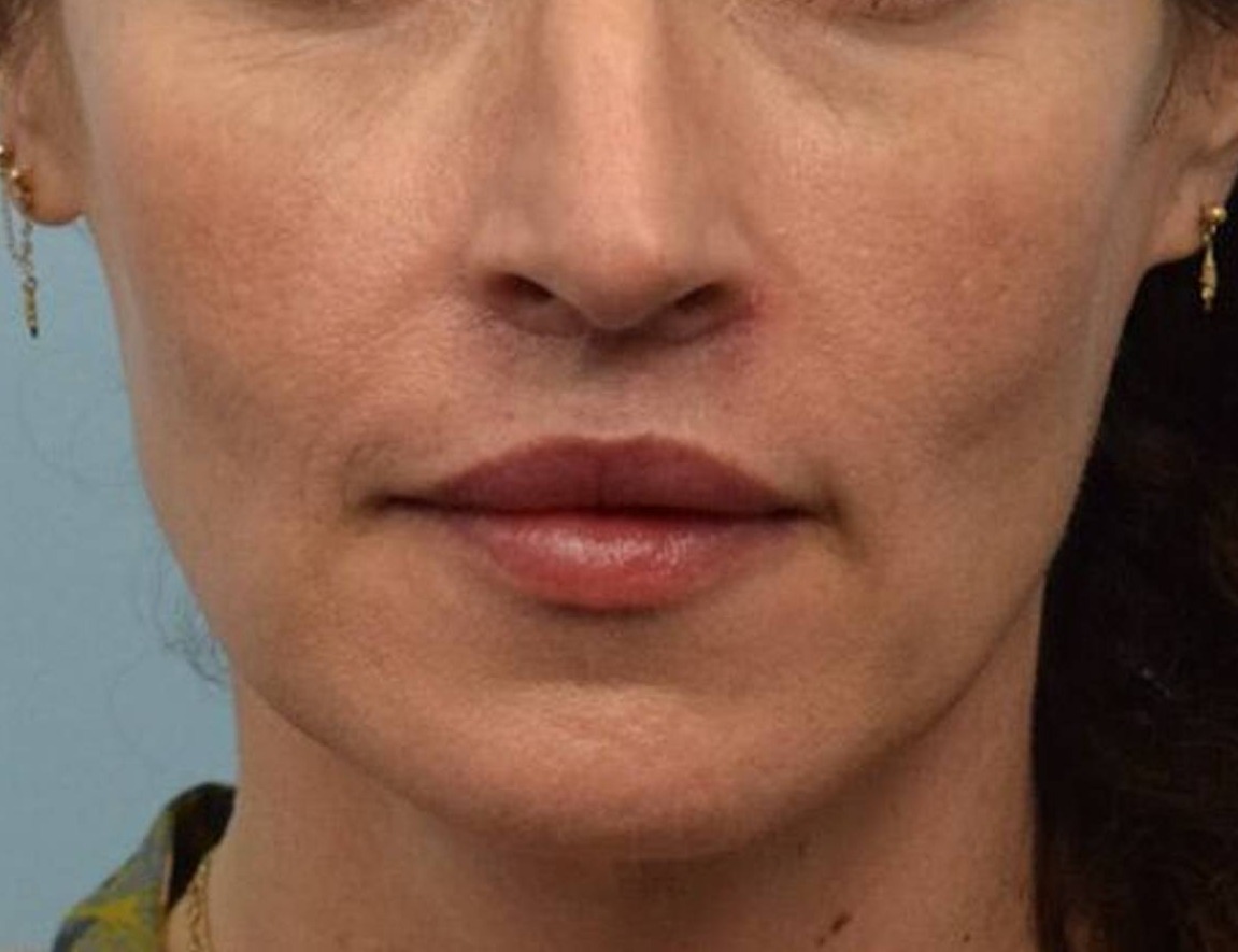 Lip Lift Before & After Image