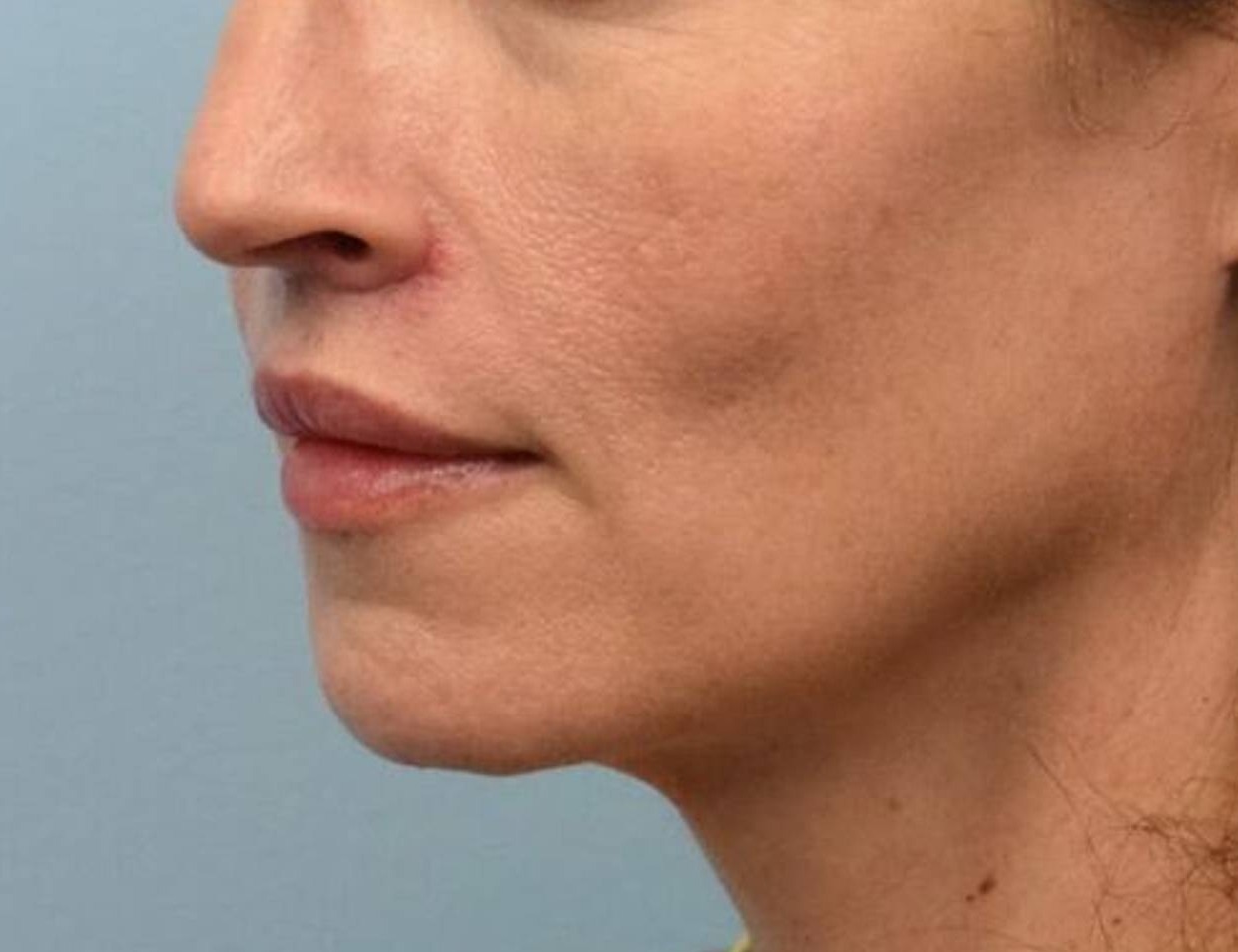 Lip Lift Before & After Image