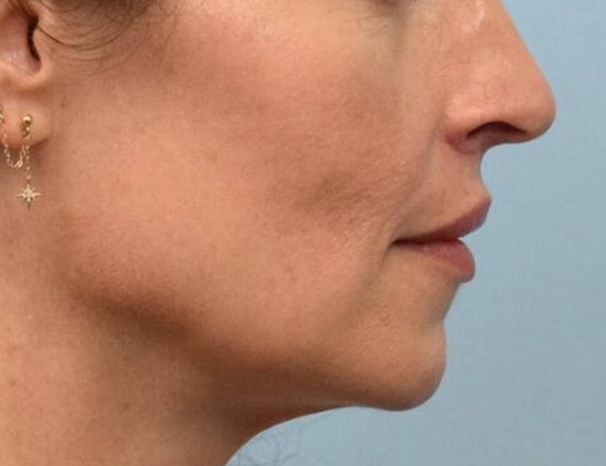 Lip Lift Before & After Image